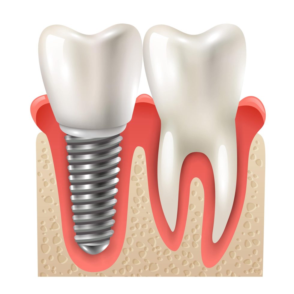 Dental Implants in Nairobi