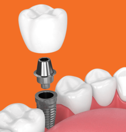 Dental Implants in Nairobi: Implants and Braces Nairobi 