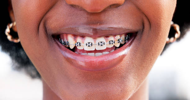 Dental Braces: What Are Dental Braces?
