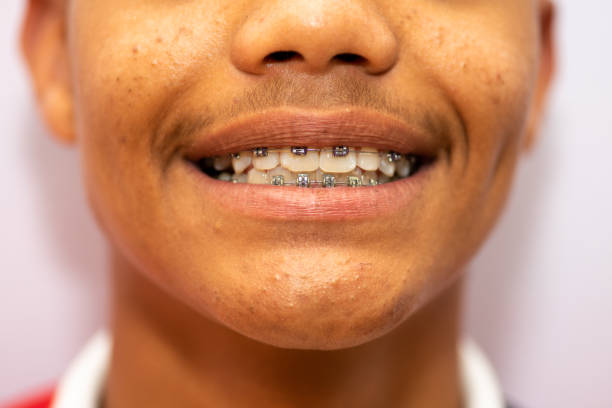 Teeth Braces Types: A Complete Guide
