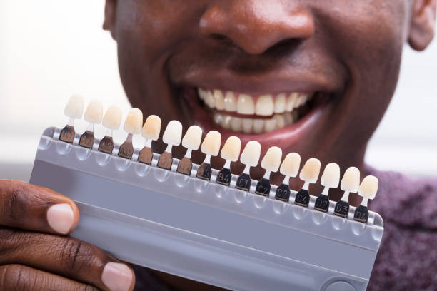 Dental Implants Cost in Kenya: What You Need to Know