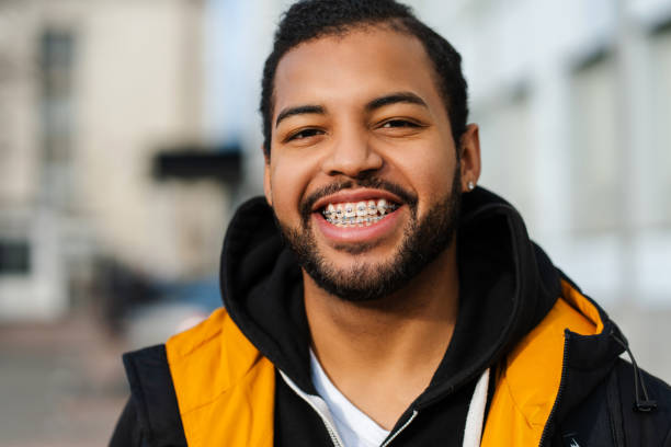 Benefits of Teeth Braces: More Than Just a Straighter Smile