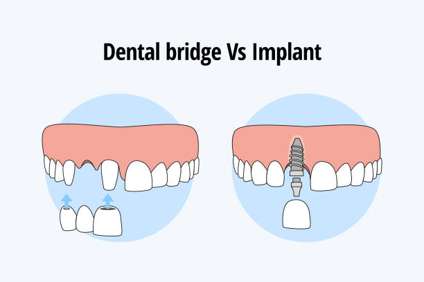 Dental Implants vs Bridges: Which Is the Better Option for Replacing Missing Teeth?