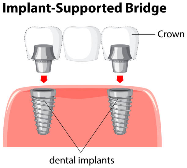 Dental Implants and Crowns: How They Work Together