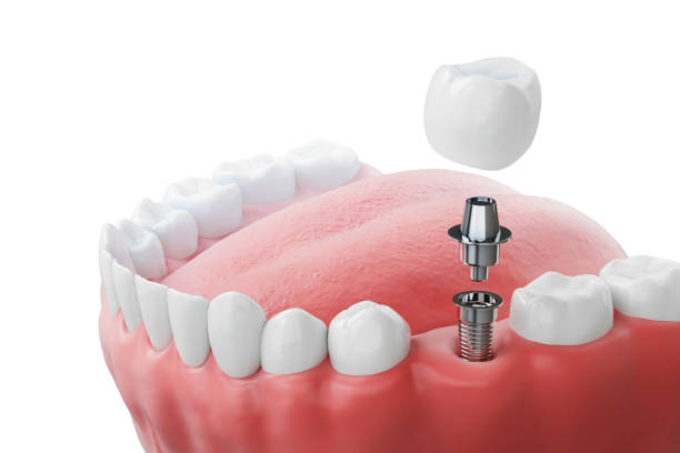 Dental Implants and Crowns: Understanding How They Work Together