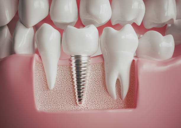 Dental Implants and Crowns: Understanding How They Work Together