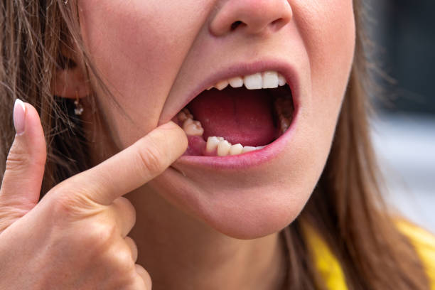 What Happens If You Delay Replacement of a Missing Tooth?