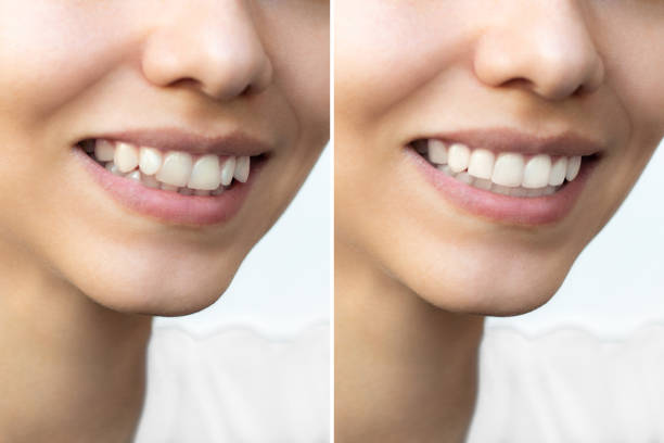 Dental Braces Guide: 5 Important Before and After Tips