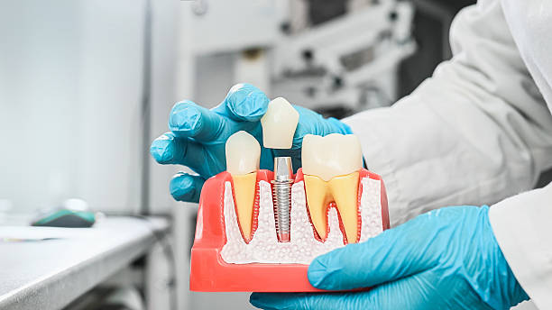 Best Dental Implants Specialist in Kenya: 5 Tips on how to choose