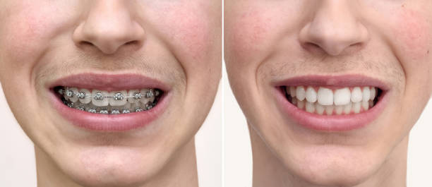 Before and After Dental Braces: What Results Can You Expect?